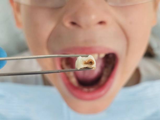 Best Emergency Dental Filling Replacement  in Cortland, NY